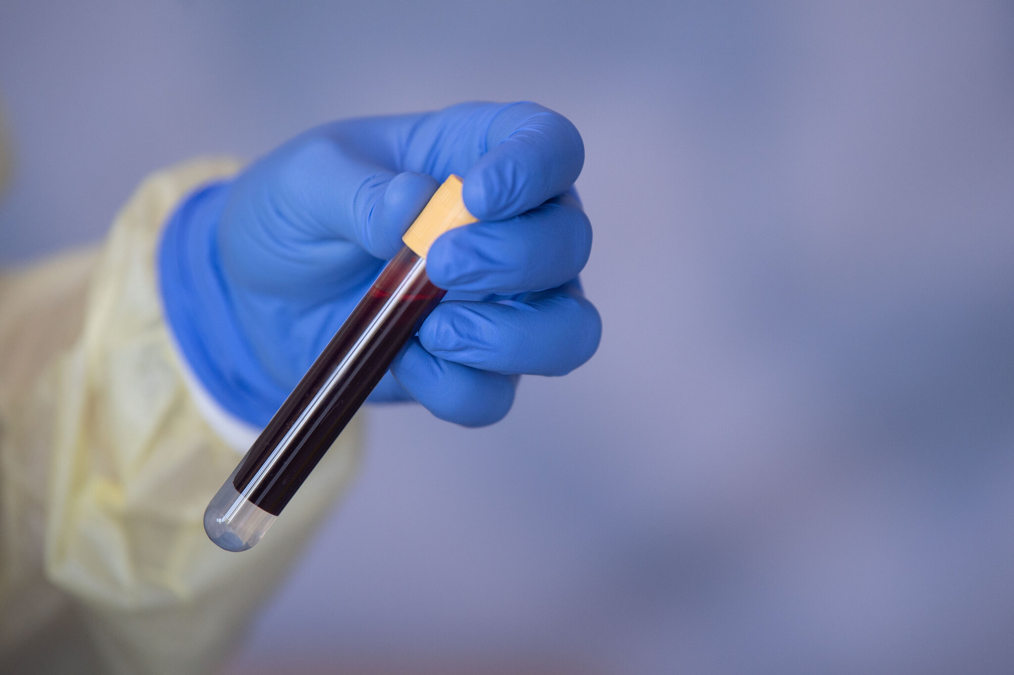 Grail’s Cancer Detection Test Fails in Major Study