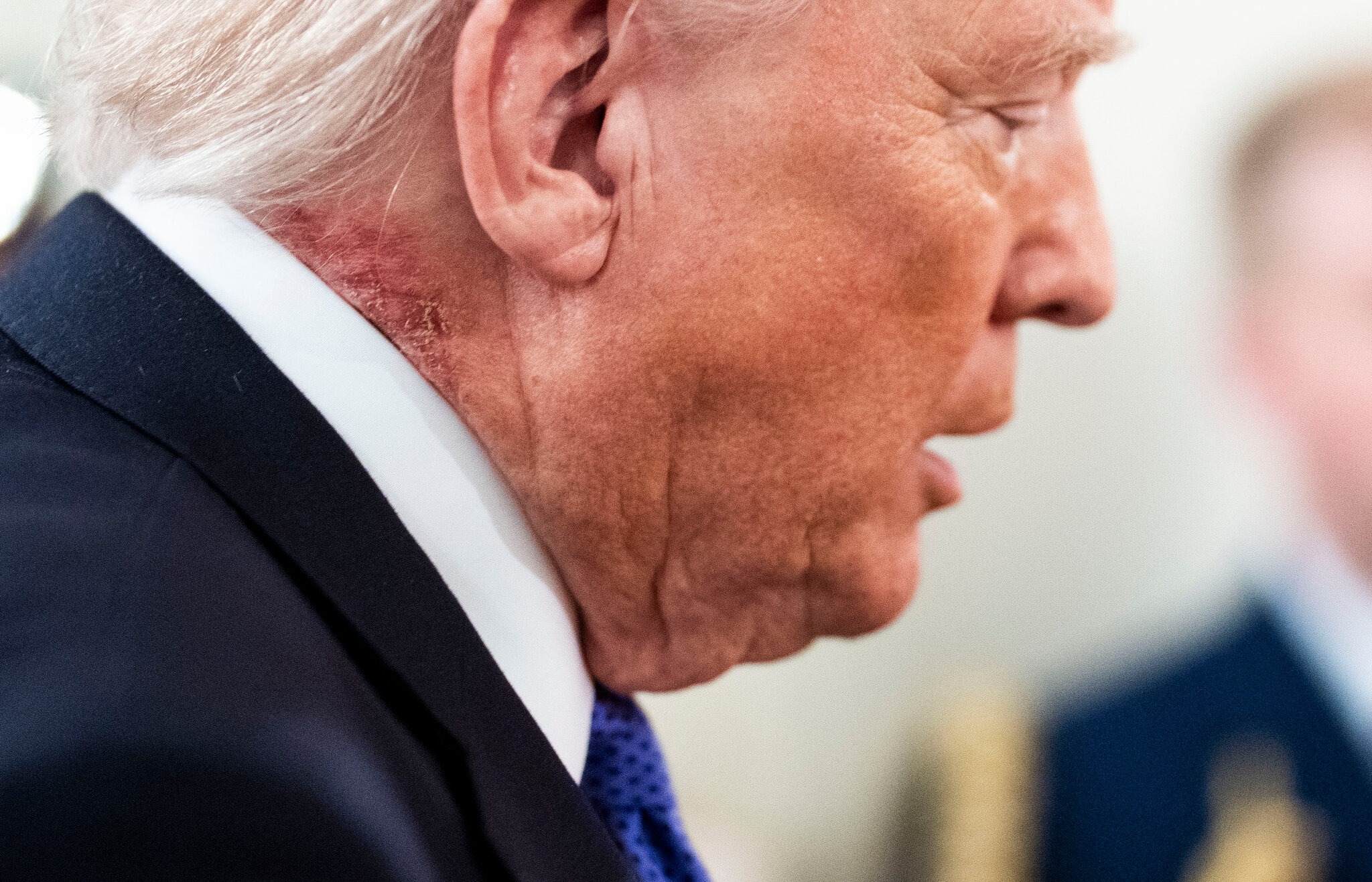 Latest Question on Trump’s Health: What Is That Neck Rash?