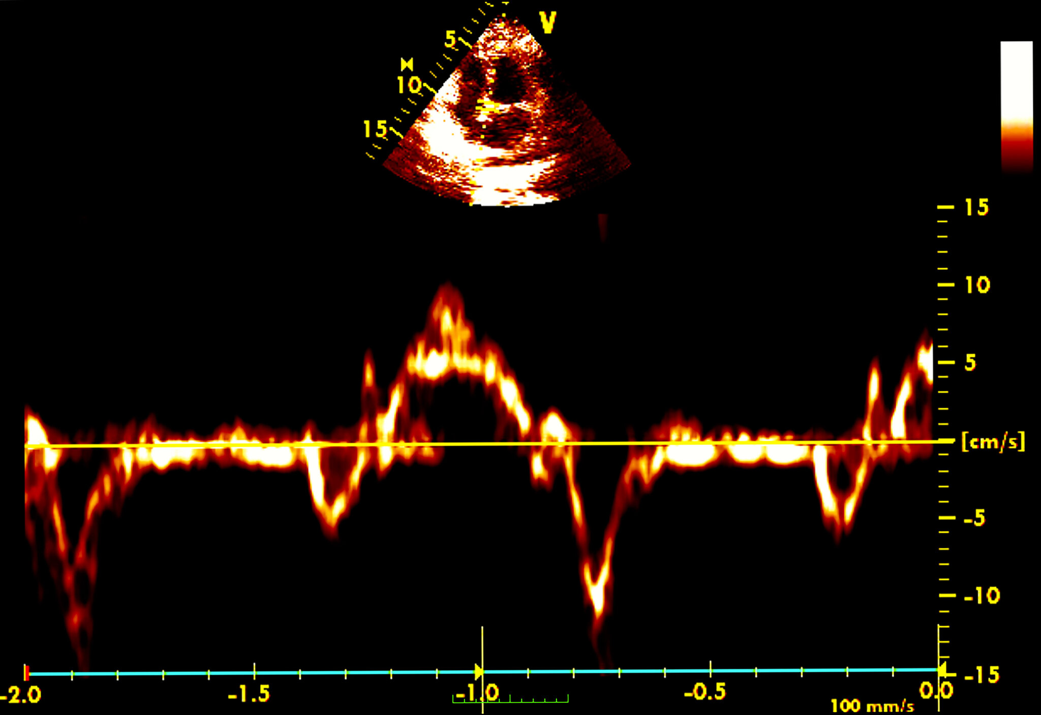 Women Who Undergo Menopause Before 40 Face Higher Heart Attack Risk