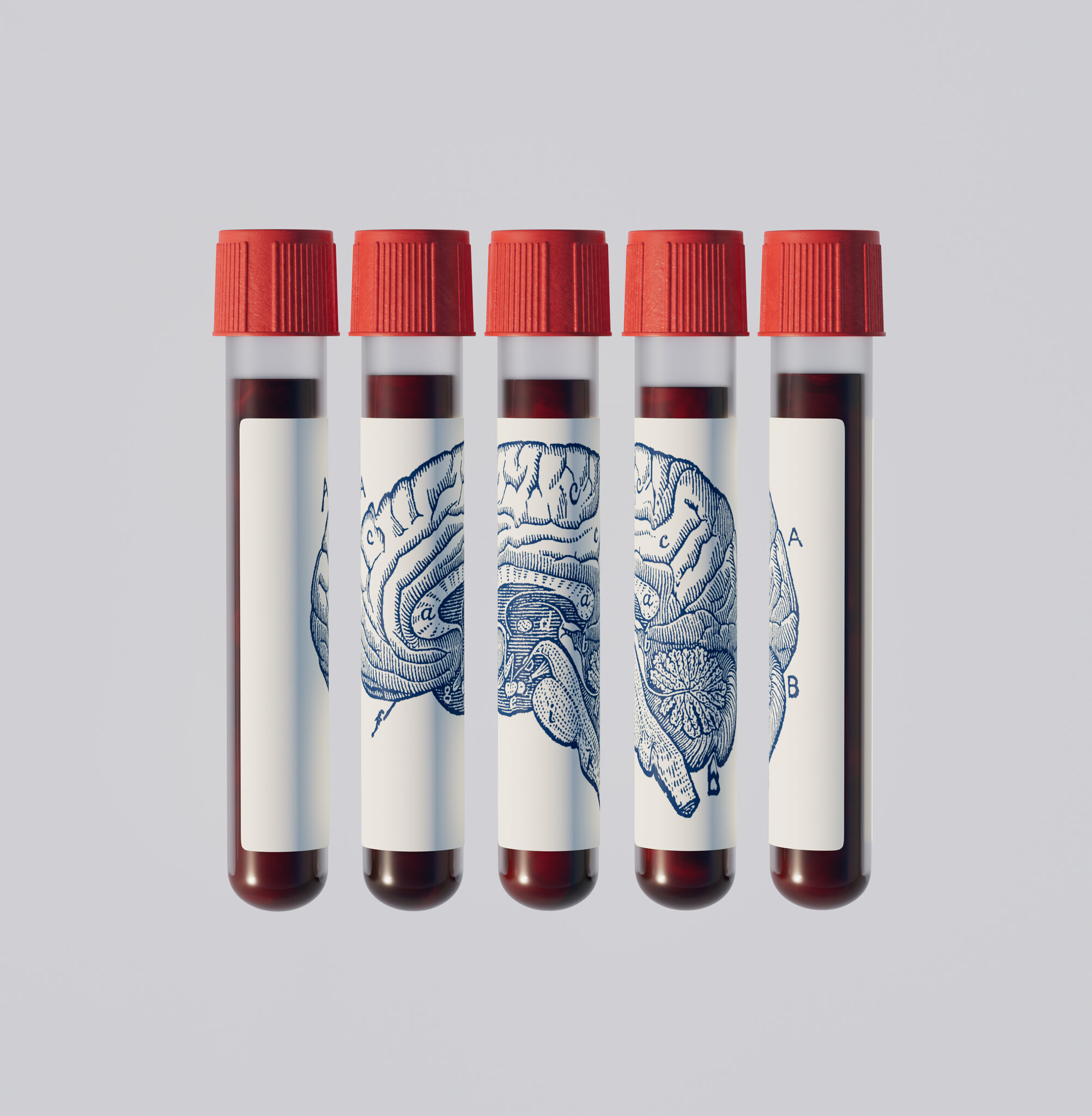 Could a Blood Test Predict if You’ll Get Alzheimer’s?