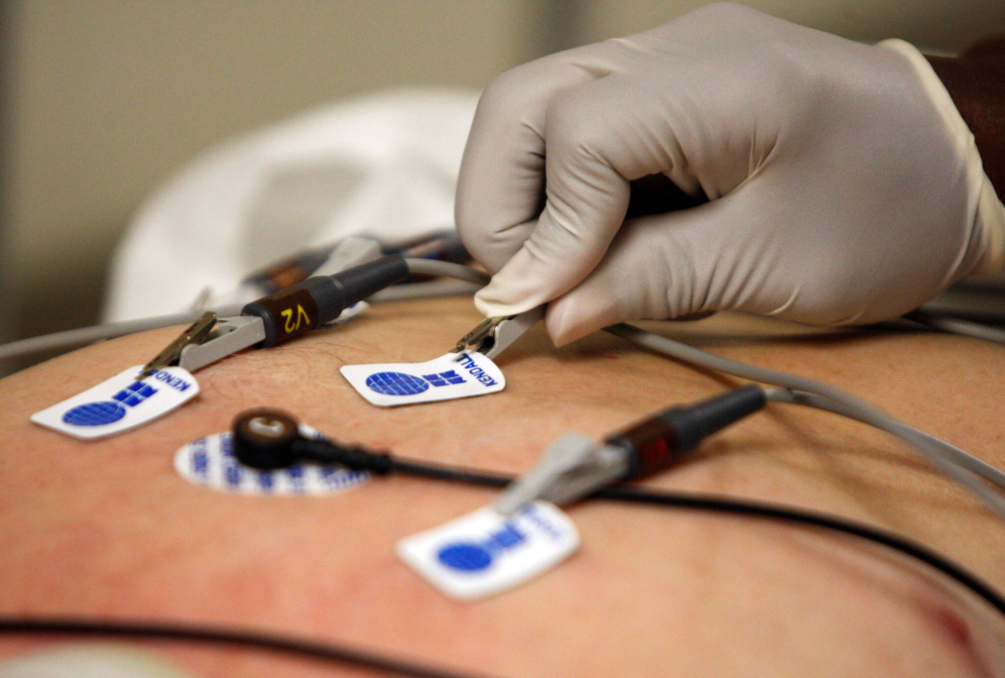 Doctors Thought It Was Asthma. A.I. Flagged a Serious Heart Problem.